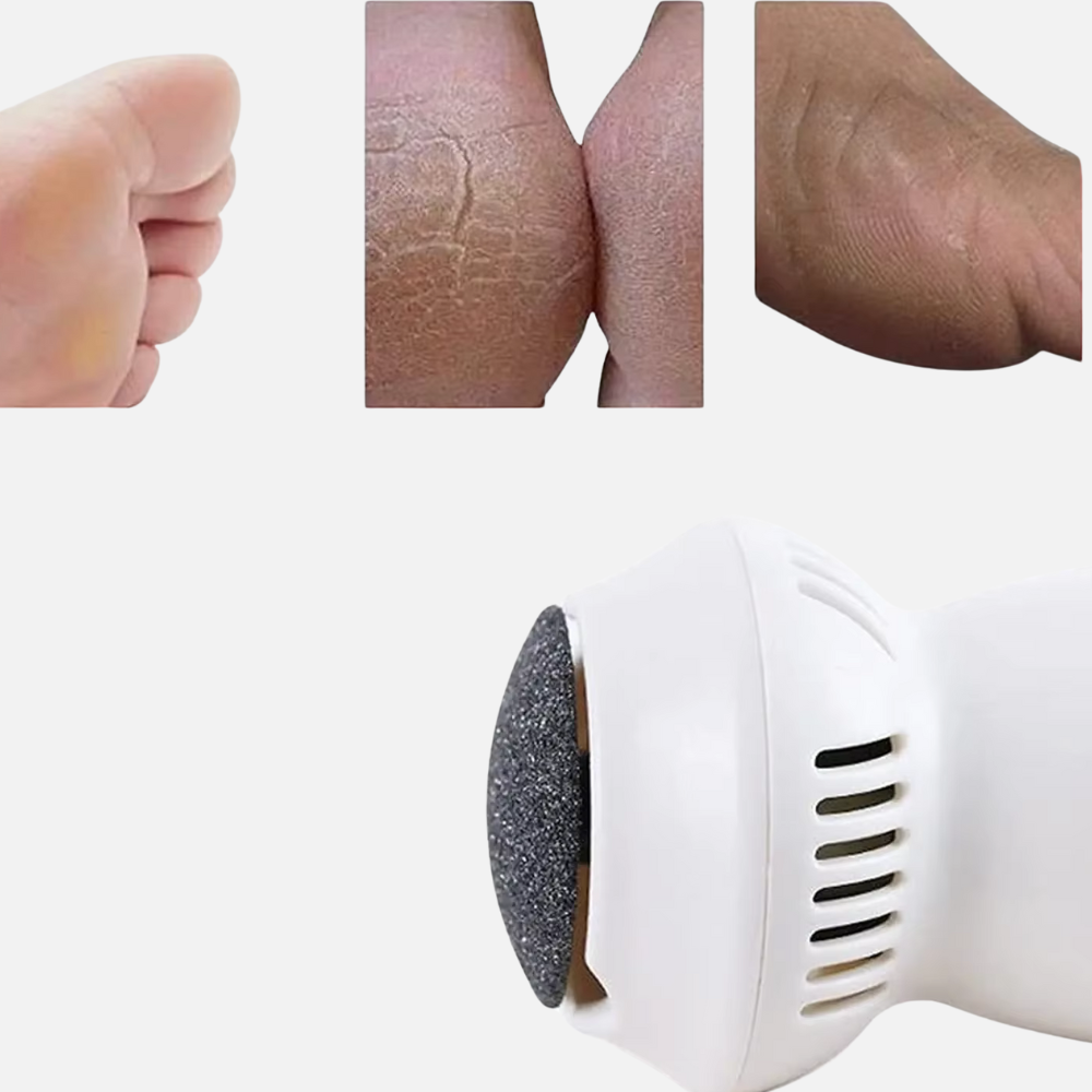 White Foot Callus Remover - Vacuum Powered Suction